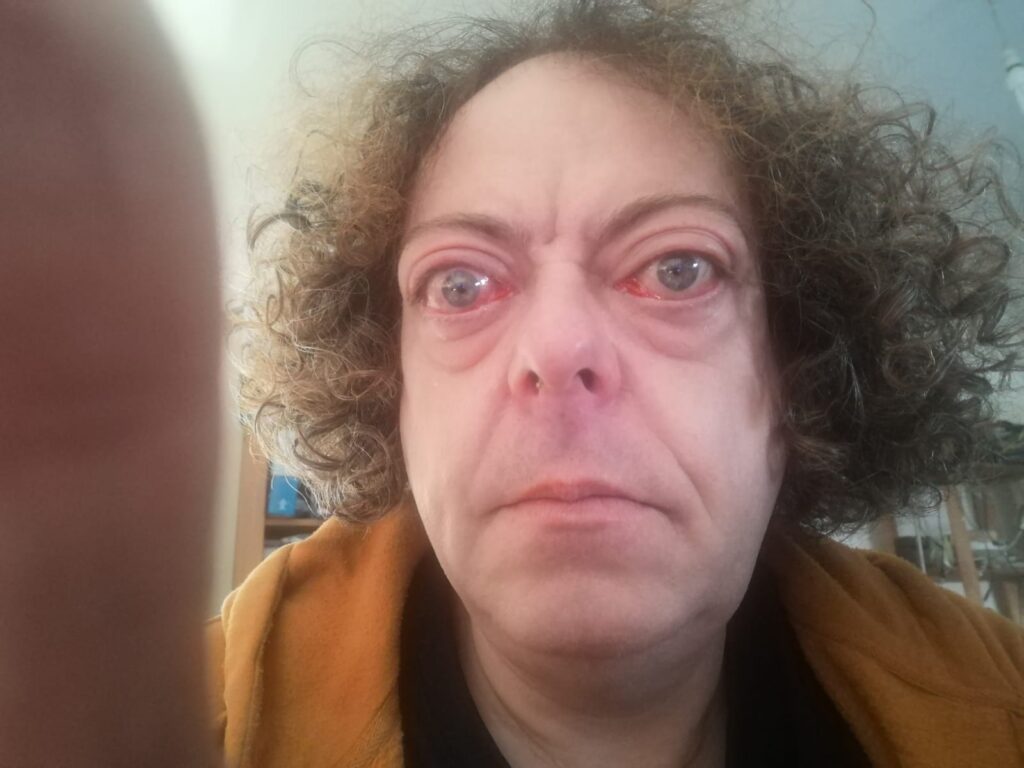 Midway through steroid treatment