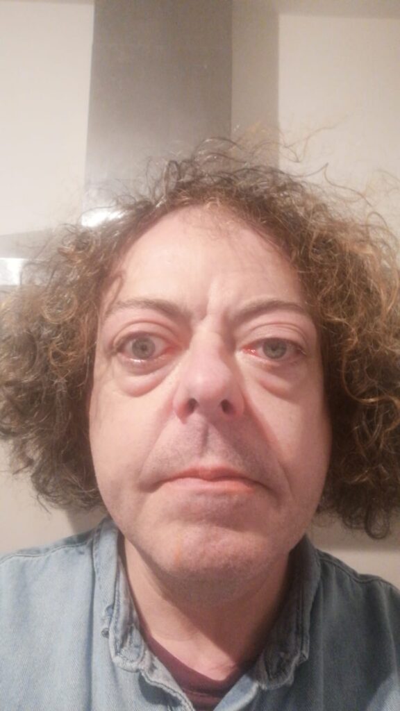 After steroid treatment